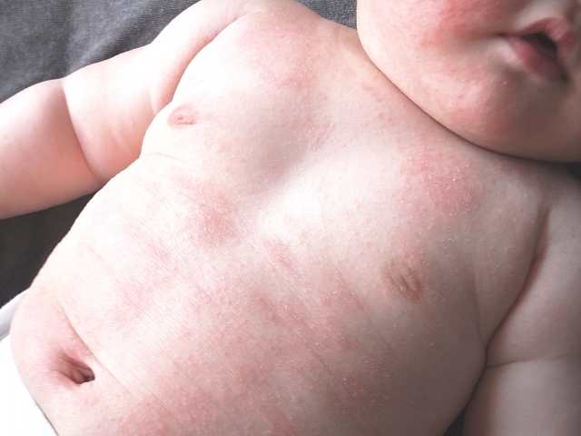 生まれる前からのアレルギー予防